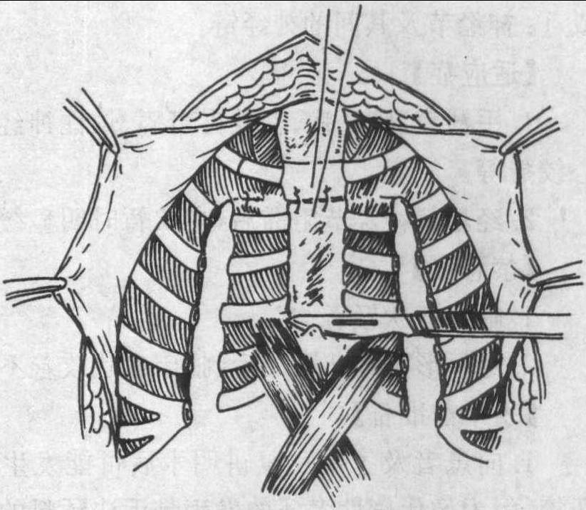 第四節(jié) 漏斗胸矯治術(shù)(胸骨翻轉(zhuǎn)法)